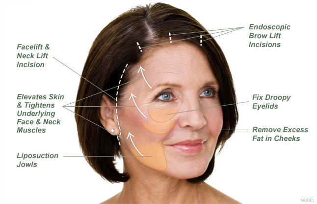 Facial Rejuvenation in a Facelift Procedure with Dr. Duplechain in Lafayette