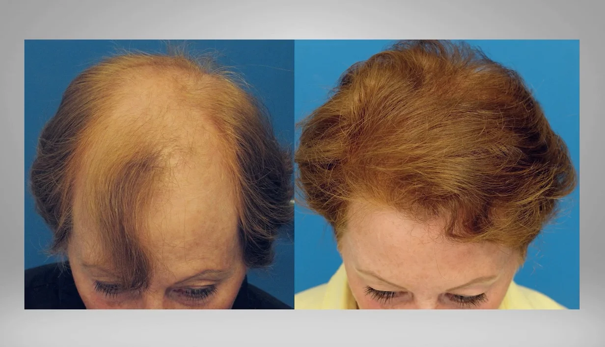Hair Transplant Baton Rouge Louisiana