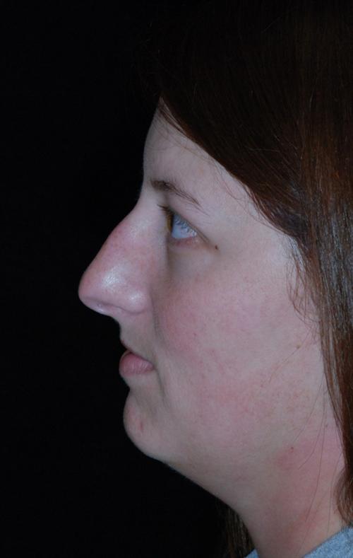 Rhinoplasty & Neck Liposuction Case 1