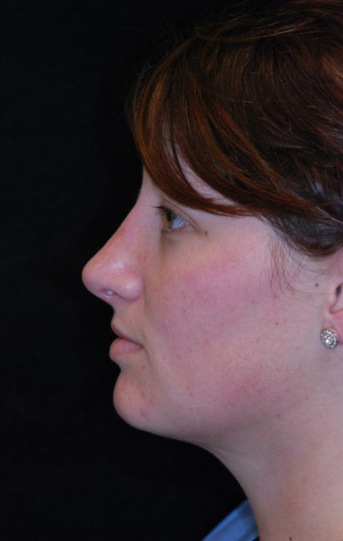 Rhinoplasty & Neck Liposuction Case 1