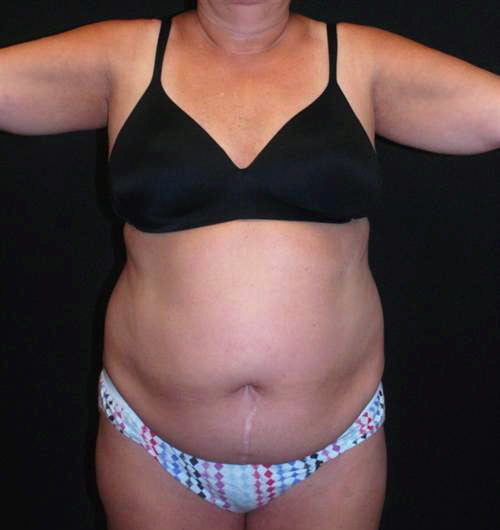 Tummy Tuck & Liposuction Case 10