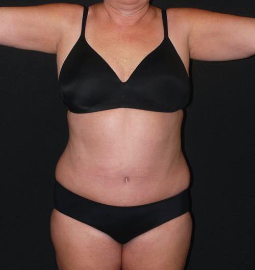 Tummy Tuck & Liposuction Case 10