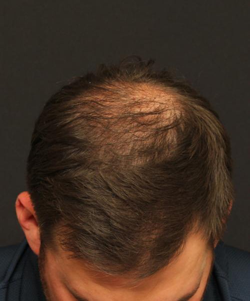 Hair Restoration Case 101