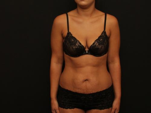 Tummy Tuck & Liposuction Case 108