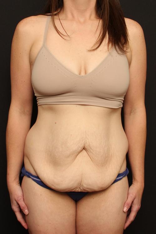Tummy Tuck & Liposuction Case 111