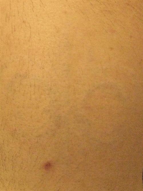 Tattoo Removal Case 14