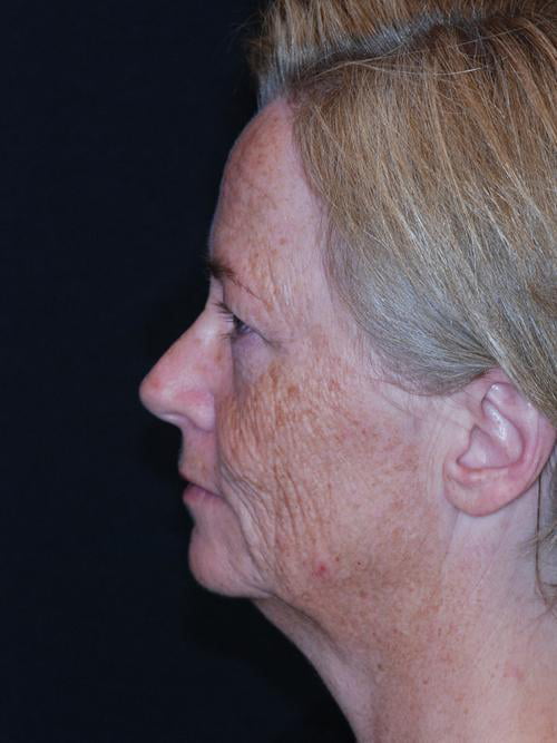 Neck Lift Case 140