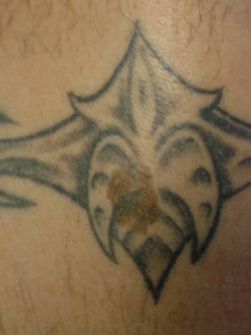 Tattoo Removal Case 15