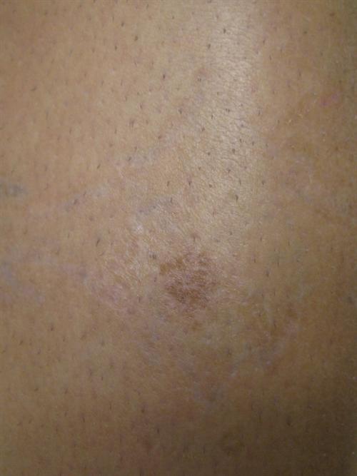 Tattoo Removal Case 15
