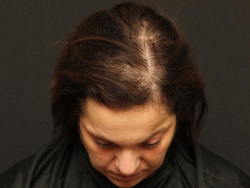 Hair Restoration Case 39