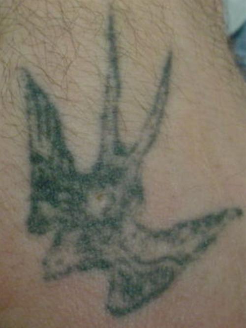 Tattoo Removal Case 16