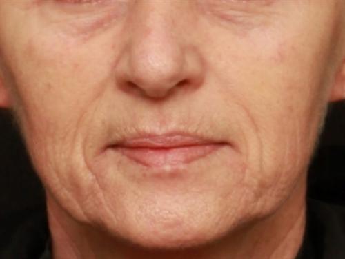 Laser Skin Resurfacing Case 162