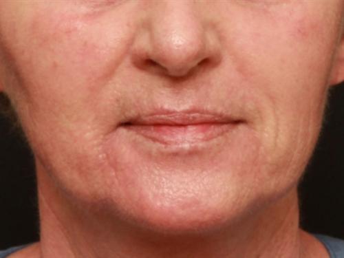 Laser Skin Resurfacing Case 162