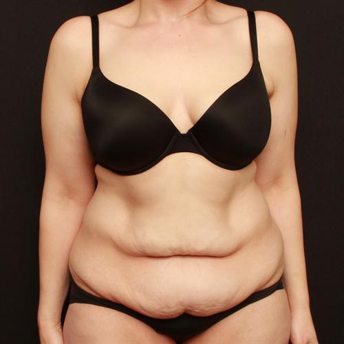 Tummy Tuck Case 165