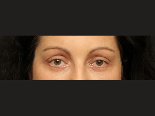 Eyelid Surgery Case 166