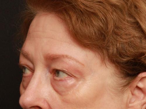 Eyelid Surgery Case 169