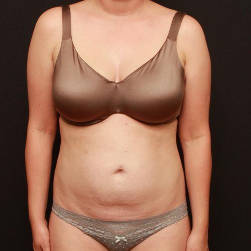 Tummy Tuck Case 170