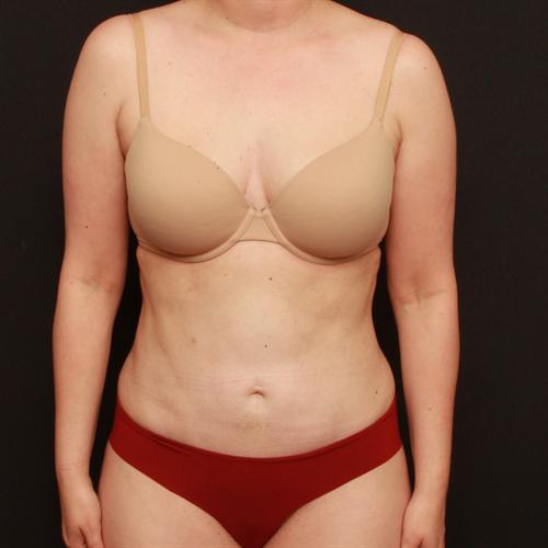 Tummy Tuck Case 170