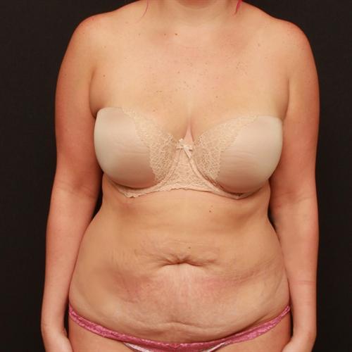 Tummy Tuck & Liposuction Case 183