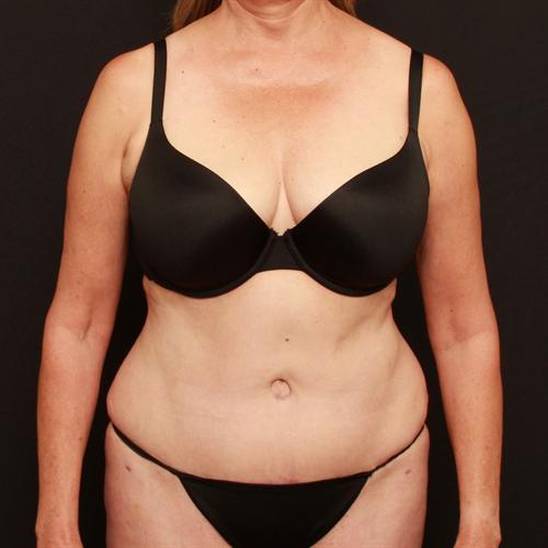 Tummy Tuck Case 184
