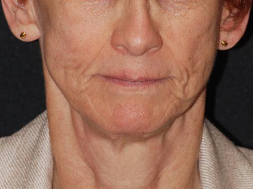 Laser Skin Resurfacing Case 19