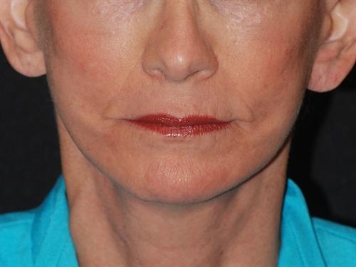 Laser Skin Resurfacing Case 19