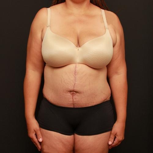 Tummy Tuck Case 193