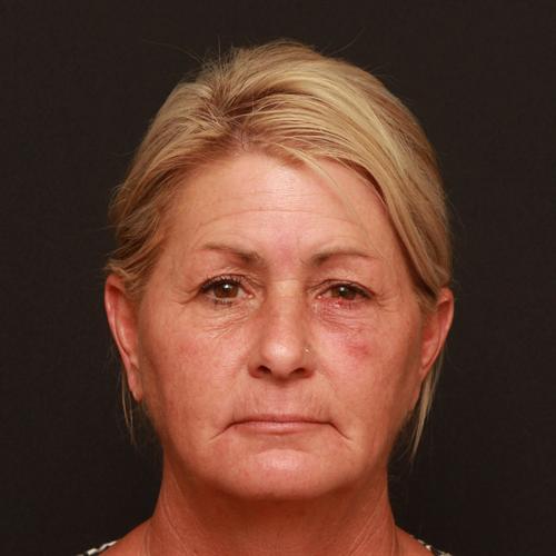 Face Lift Case 194