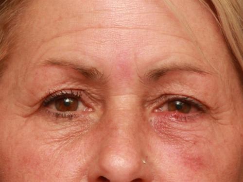 Eyelid Surgery Case 195