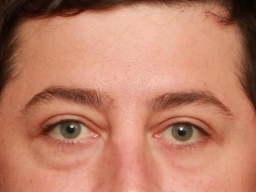 Eyelid Surgery Case 198