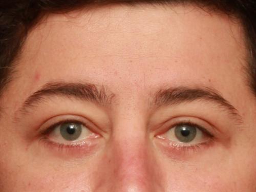 Eyelid Surgery Case 198