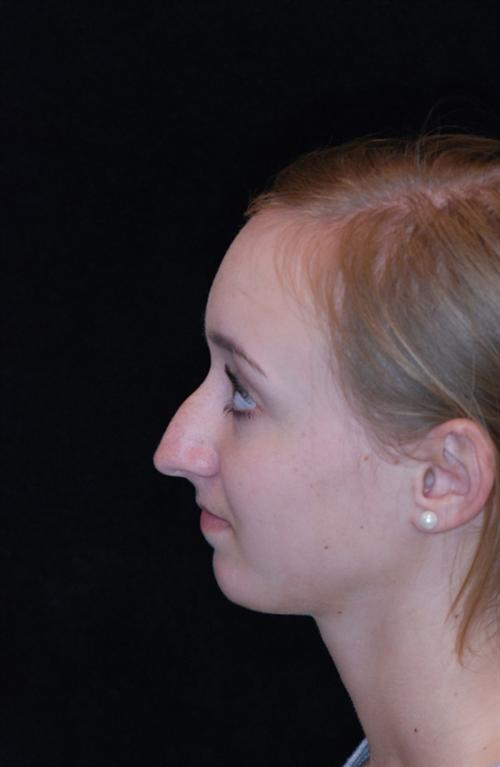 Rhinoplasty Case 2