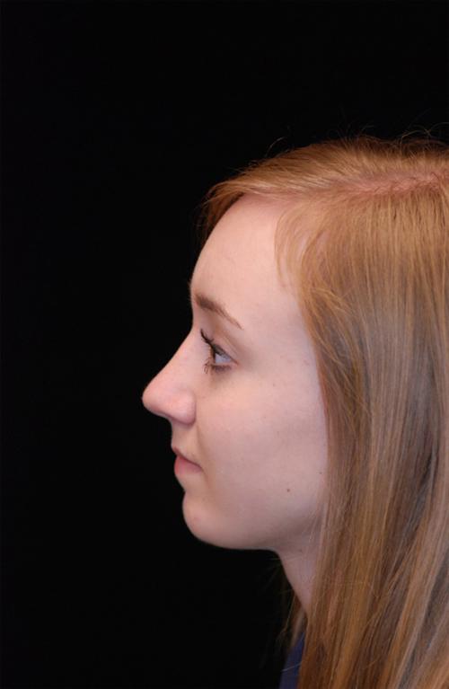 Rhinoplasty Case 2