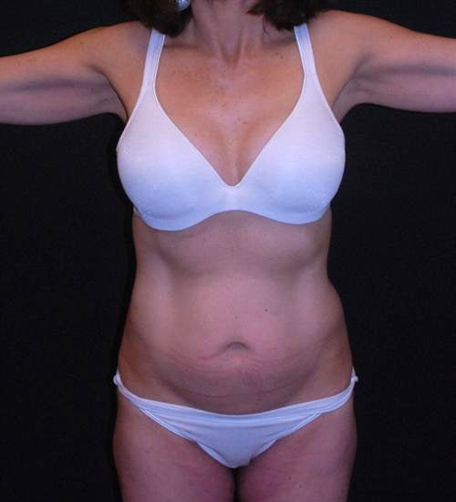 Tummy Tuck & Liposuction Case 20