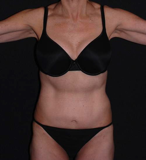 Tummy Tuck & Liposuction Case 20