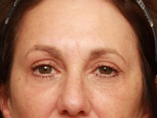 Eyelid Surgery Case 200