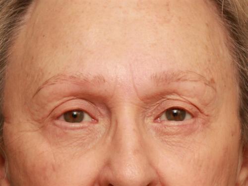 Eyelid Surgery Case 202