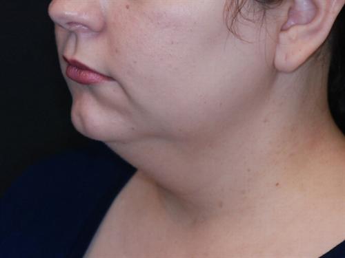 Neck Lift with Liposuction Case 21