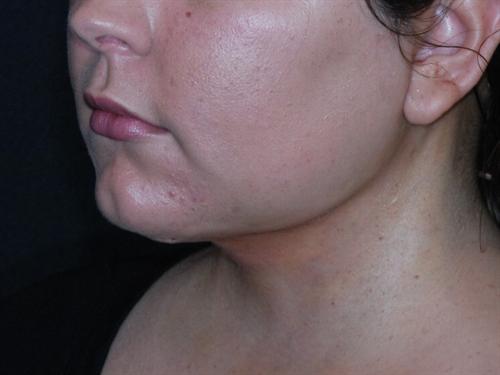 Neck Lift with Liposuction Case 21