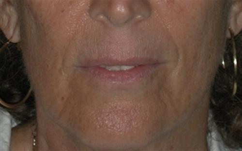 Laser Skin Resurfacing Case 23