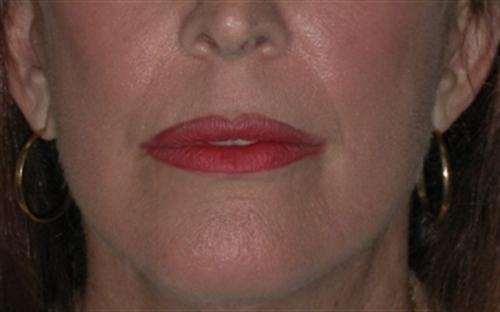 Laser Skin Resurfacing Case 23