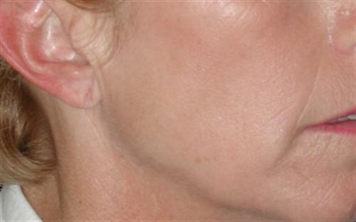 Laser Skin Resurfacing Case 24