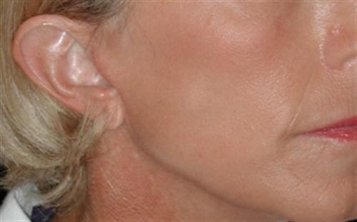 Laser Skin Resurfacing Case 24