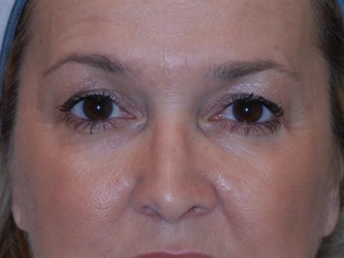 Eyelid Surgery Case 25