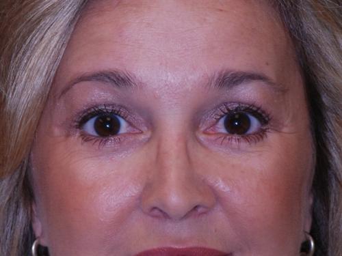 Eyelid Surgery Case 25