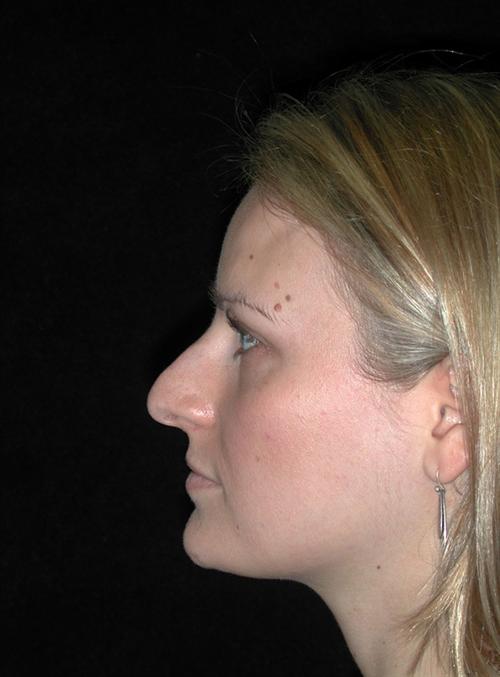 Rhinoplasty Case 3