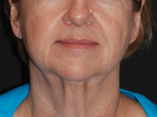 Laser Skin Resurfacing Case 31