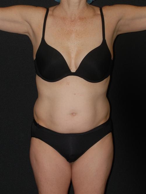 Tummy Tuck Case 37