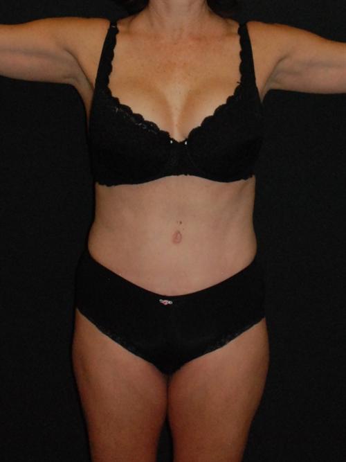 Tummy Tuck Case 37