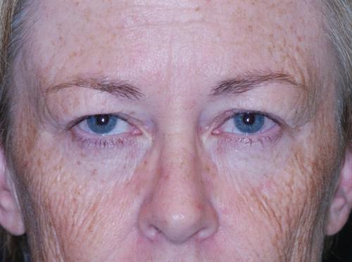 Eyelid Surgery Case 4